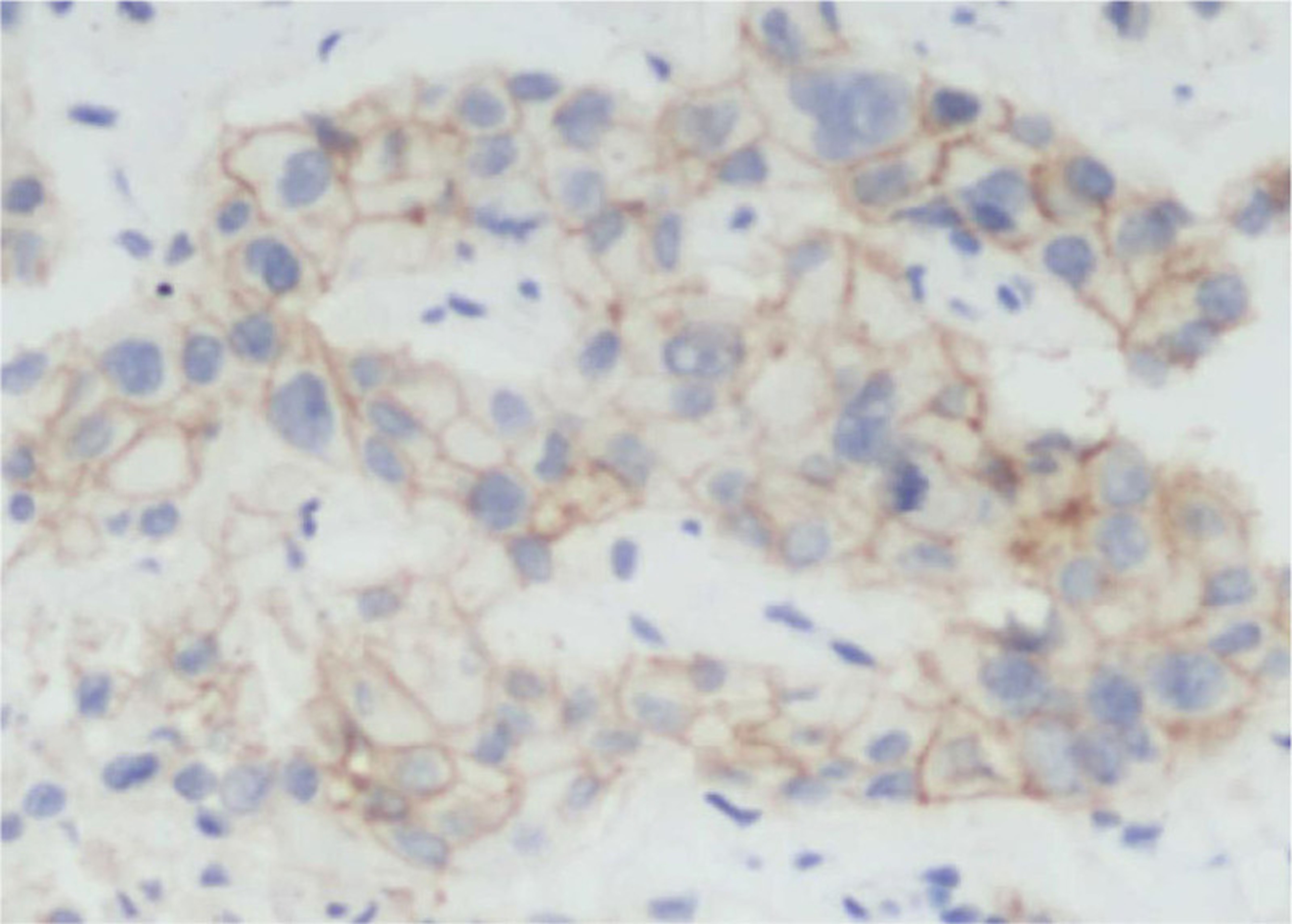 【佳学基因检测】基因检测具有ALK 融合突变而且是高 PD-L1 表达的晚期肺腺癌患者 ALK-TKI 靶向药物治疗 【佳学基因检测】基因检测具有ALK 融合突变而且是高 PD-L1 表达的晚期肺腺癌患者 ALK-TKI 靶向药物治疗